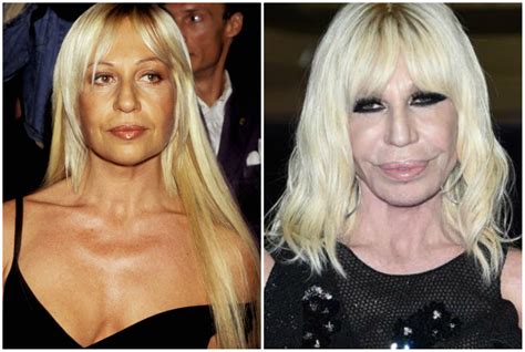 donatella versace chirurgia